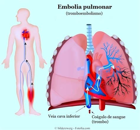 embolia pulmonar